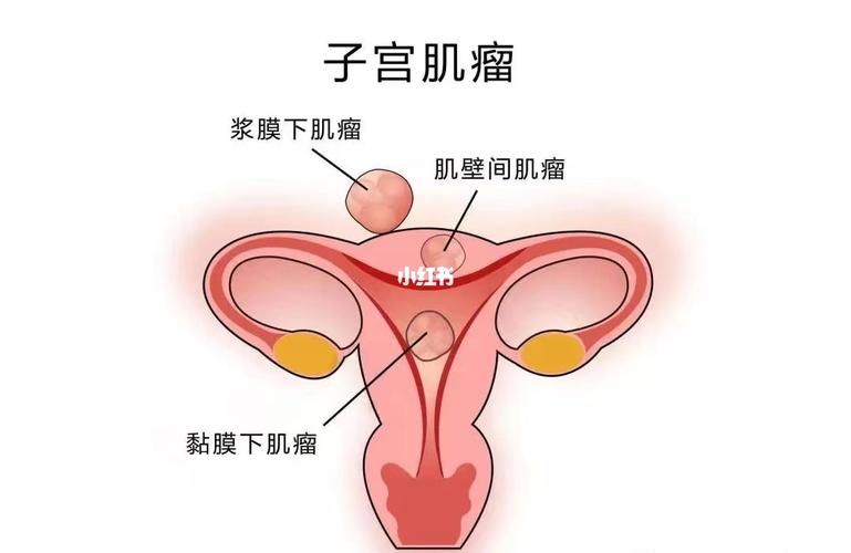 子宫肌瘤患者最主要的症状是-子宫肌瘤的典型症状是